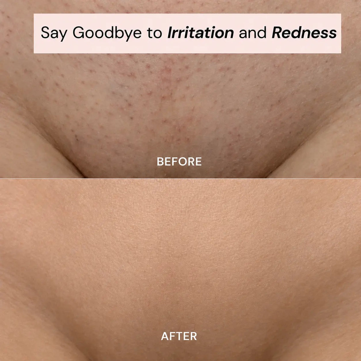 Ylumea 2-in-1 - Intimate Hair Remover