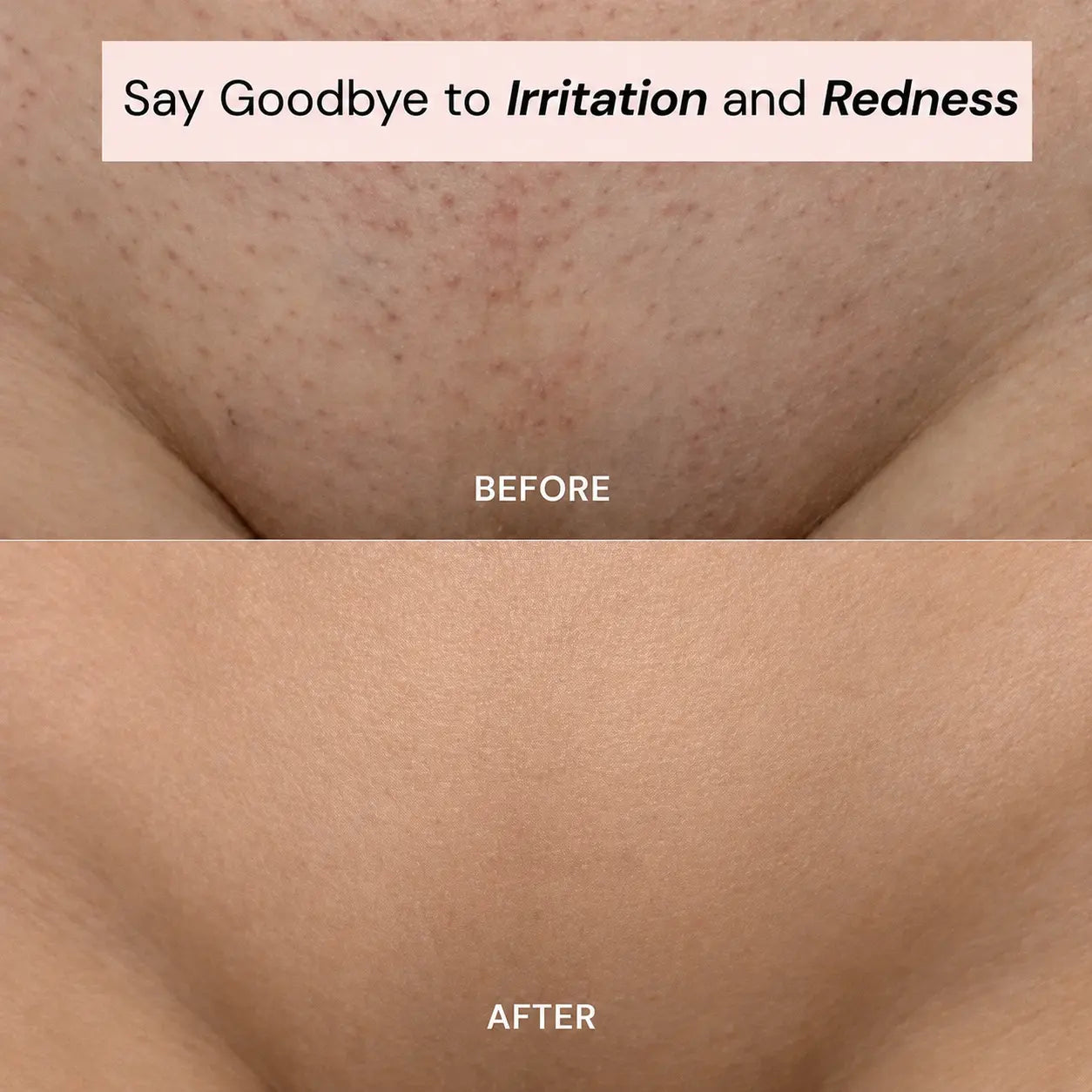 Ylumea 2-in-1 - Intimate Hair Remover